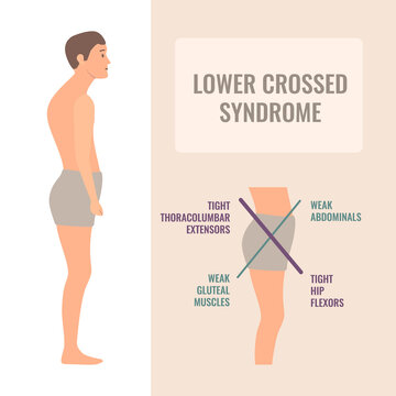 Lower crossed syndrome medical diagram. Crooked man with muscle strength imbalance. Weak and overactive pelvis muscles therapy. Incorrect spine curvature caused by bad posture. Vector illustration.