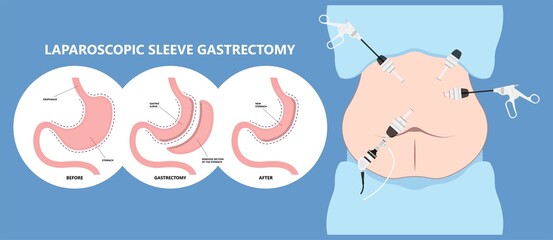 Gastric bypass surgery and Band roux en y procedure endoscopy weight loss hiatal hernia diet food full body mass index or BMI reflux GERD eat obese clinic tummy tuck small lap sleep apnea high blood