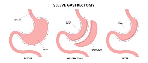 Fototapeta premium Gastric bypass surgery and Band roux en y procedure endoscopy weight loss hiatal hernia diet food full body mass index or BMI reflux GERD eat obese clinic tummy tuck small lap sleep apnea high blood