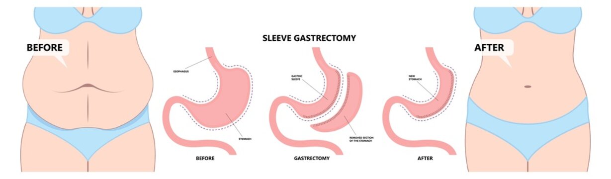 Gastric bypass surgery and Band roux en y procedure endoscopy weight loss hiatal hernia diet food full body mass index or BMI reflux GERD eat obese clinic tummy tuck small lap sleep apnea high blood