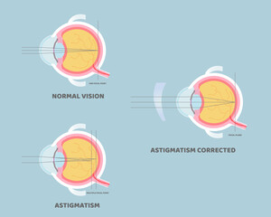 eyeball anatomy, internal organs body part nervous system, astigmatism corrected, eyesight concept, vector illustration cartoon flat design clip art