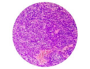 Photomicrograph of a schwannoma, a benign soft tissue tumor of peripheral nerve sheath.