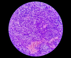 Photomicrograph of a schwannoma, a benign soft tissue tumor of peripheral nerve sheath.