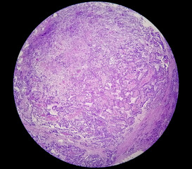 Stomach cancer: Adenocarcinoma of stomach, antrum cancer. High grade acute Inflammation near the tumor nests. Microscopic view.