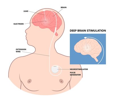 Deep brain stimulation or DBS treat Parkinson's disease PD and TMS condition major neural stimulator pulse neurological wave implanted Motor bipolar