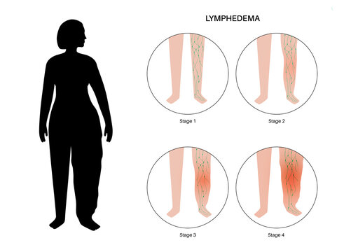 Stages Of Lymphedema