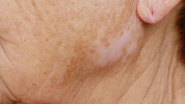 Spots on skin of elderly woman face. Pigmentation on female face. Close up. Side view