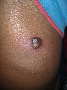 Furuncle on infected skin of a black man with pus abscess in the city of Porteirinha, Minas Gerais, Brazil, South America.