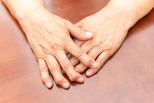 Hands of elderly woman with rheumatoid arthritis, deformed fingers