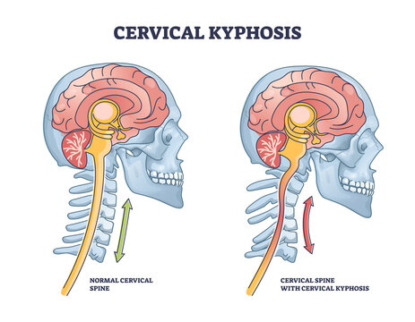 Cervical kyphosis condition with spine and neck curvature outline diagram. Labeled educational military neck syndrome compared to healthy posture vector illustration. Human body deformity anatomy.