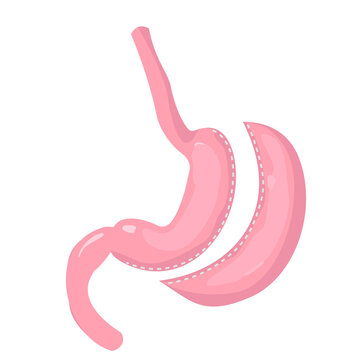 Gastric sleeve stomach. Methods of bariatric surgery. Human anatomy illustration for infographics, atlas, textbook or study material.