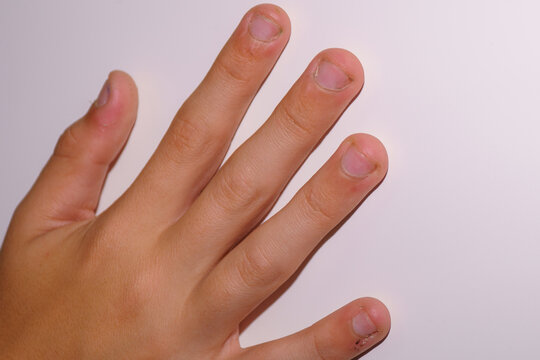 Nail biting: Side effects, causes and management