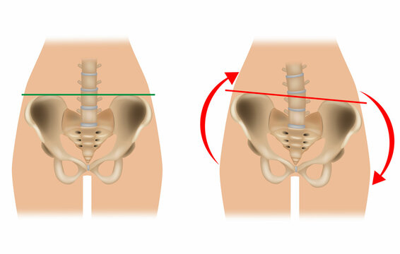Comparison of pelvic distortion. Normal pelvis and distorted pelvis. A Twisted Pelvis, also called Pelvic Torsion