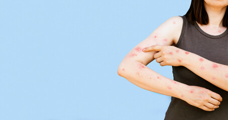 Monkeypox new disease dangerous over the world. Patient with Monkey Pox. Painful rash, red spots...