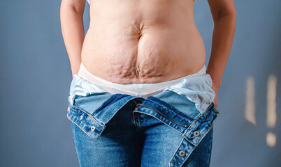 Female body with torn blue jeans. Naked belly with stretch marks. Postpartum depression.