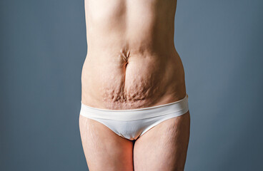Front view of the skin of a woman with stretch marks and flabby skin after childbirth. Naked belly...