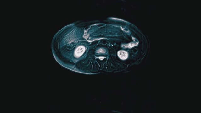Voluminous color CT scan of the abdomen. Computed tomography of the gastrointestinal tract, liver and kidneys
