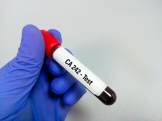 Obraz premium Urine sample for CA 242 test to diagnose for pancreatic cancer.