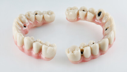 Ceramic dental prostheses on a titanium beam for top and lower jaws on a white background