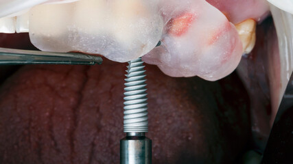 dental implant before installation into the patient's bone through a template