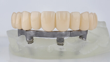 Fototapeta na wymiar Dental Prosthetic Top Jaw and Metal Beam on Models on White Background