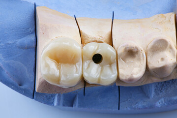 composition of ceramic dental crowns on a plaster model, top view