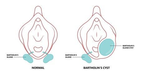 ฺฺBartholin’s cyst of vagina pain lump  mass with E. coli bacteria sex safe pelvic exam cervix swollen pus lips vulva blockage - obrazy, fototapety, plakaty