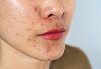 Cropped shot of woman having problems of acne inflamed on her face.