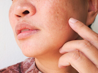 Problem skincare and health concept.Wrinkles,melasma,dark spots,freckles,dry skin on face middle age asian woman.