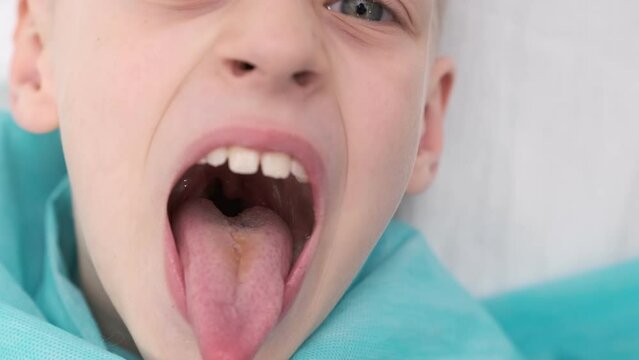 boy opens her mouth wide and pulls out long tongue. child shows his teeth soft palate and mouth to dentist. mouth is wide open, tongue is stuck out as far as possible, with clear view of tongue