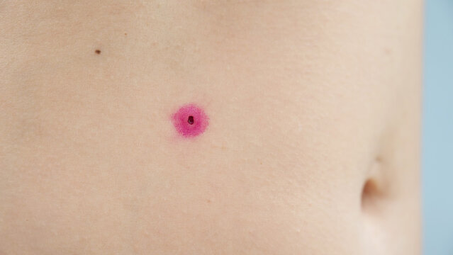 Close-up of a removed wart on a woman's abdomen. Human papillomavirus after burning.