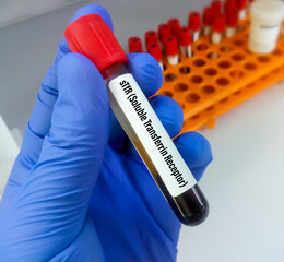 Fototapeta premium Soluble transferrin receptor (sTfR) test. this test help to detect and evaluate iron deficiency and aid in the diagnosis of iron deficiency anemia.