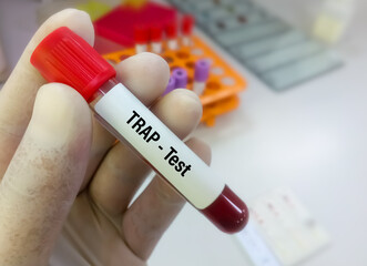 Blood sample for Tartrate resistant acid phosphatase (TRAP) test in laboratory for the diagnosis of hairy cell leukemia.