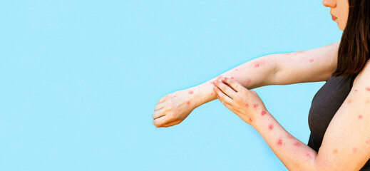 Monkeypox new disease dangerous over the world. Patient with Monkey Pox. Painful rash, red spots...