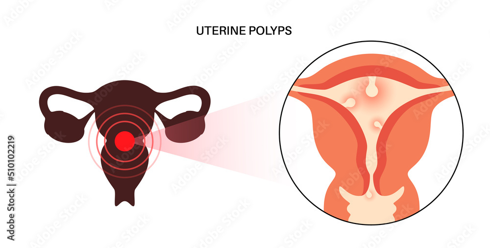 Sticker Uterus Polyps Disease