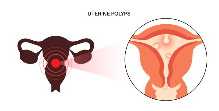Uterus Polyps Disease