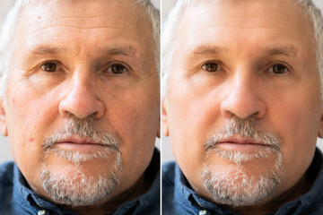 Man With Before And After Rejuvenation