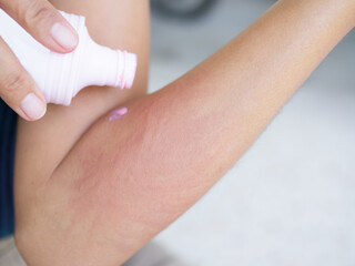 Urticaria on hand woman non-lethal type from food and air poisoning. she apply Calamine Lotion medicine on the arm her.she Sick, have an allergic reaction. Urticaria on skin body.healthcare concept.
