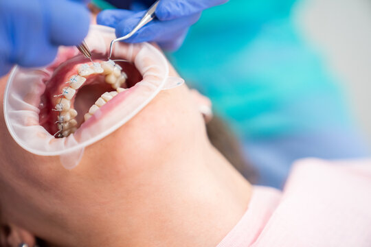 Dentist Hands Adjusting Clear Braces To Patient