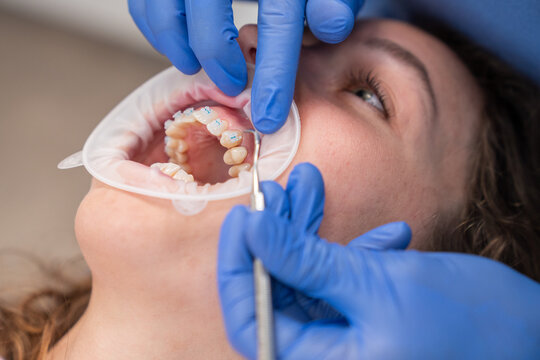 Orthodontic treatment. Adjusting Braces.