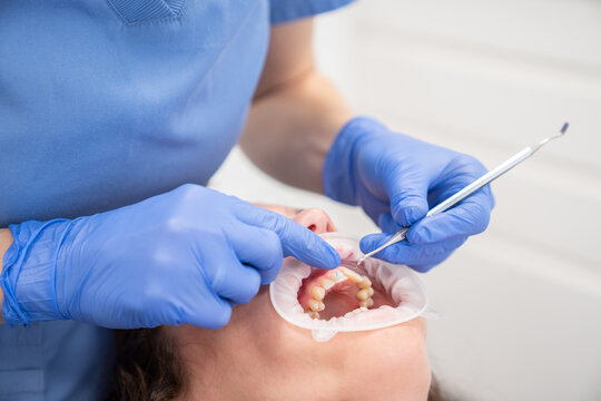 Dentist Hands Adjusting Ceramic Braces To Patient