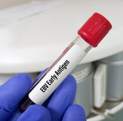 Scientist hold blood sample for EBV (Epstein-Barr virus) Early Antigen Test, EBV nuclear antigen.