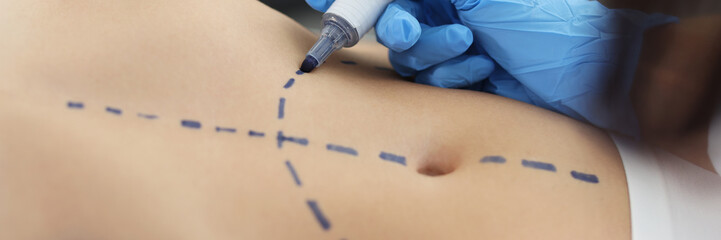 Plastic surgeon using marker pen while marking belly part of womans body