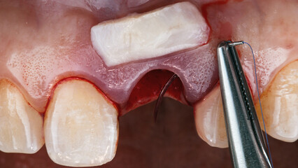 flap of soft tissue on the gum with a needle for suturing after implantation