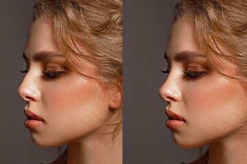 rhinoplasty before and after correction, young girl in profile