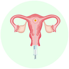 Embryo transfer. In vitro fertilization method