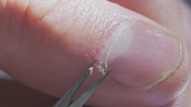 The process of removing of the hangnails using the scissors.