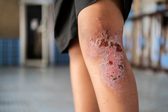 Dry scab on the wounded knee of an boy