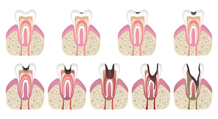 Stages of caries development. Tooth structure in flat style. Tooth decay with enamel. Dental disease caries, pulpitis and periodontitis, realistic vector illustration