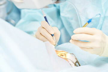 Ophthalmology laser microscope operation. Doctor surgery in clinic. Patient eye treatment. Myopia...